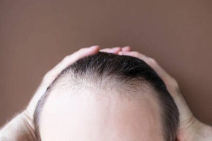 How-Can-Hair-Loss-Treatment-Improve-Hairline-Shape