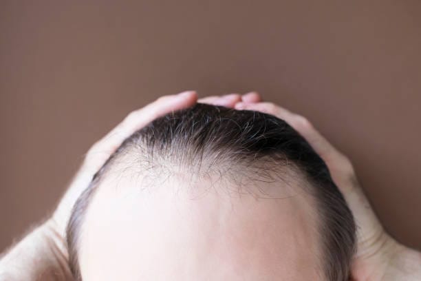 How-Can-Hair-Loss-Treatment-Improve-Hairline-Shape