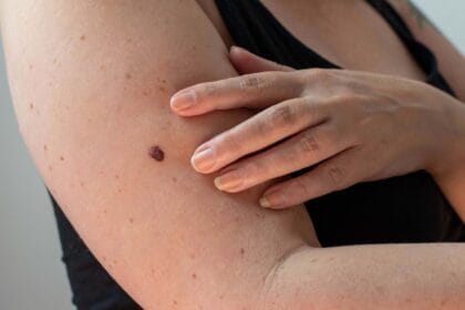 How-Can-Mole-Removal-Boost-Your-Confidence