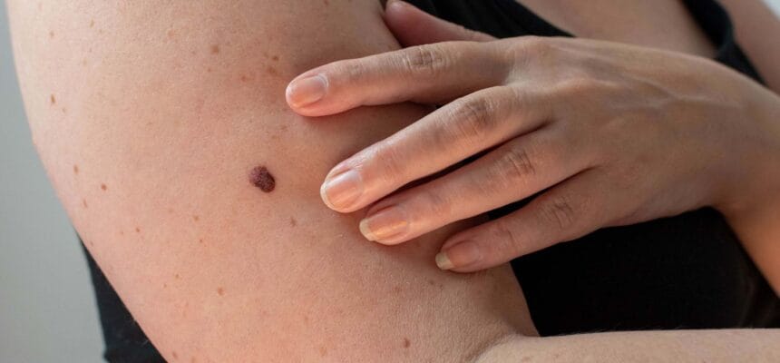 How-Can-Mole-Removal-Boost-Your-Confidence