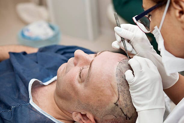 How-Does-FUE-Hair-Transplant-Support-Hair-Growth