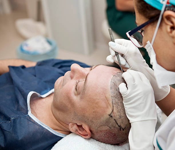 How-Does-FUE-Hair-Transplant-Support-Hair-Growth