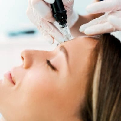 How-Does-Microneedling-Support-Natural-Skin-Healing