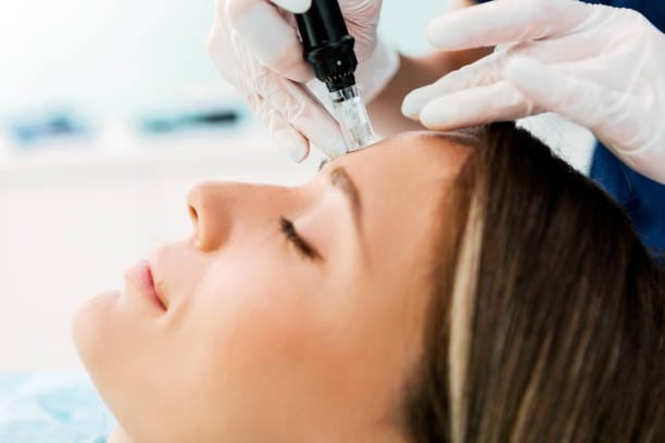 How-Does-Microneedling-Support-Natural-Skin-Healing