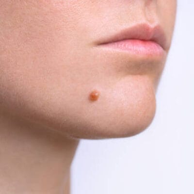 How-Does-Mole-Removal-Work-on-Sensitive-Skin-Areas