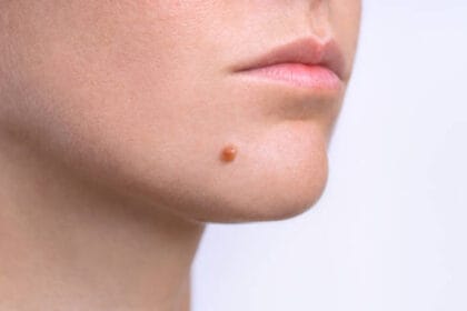 How-Does-Mole-Removal-Work-on-Sensitive-Skin-Areas