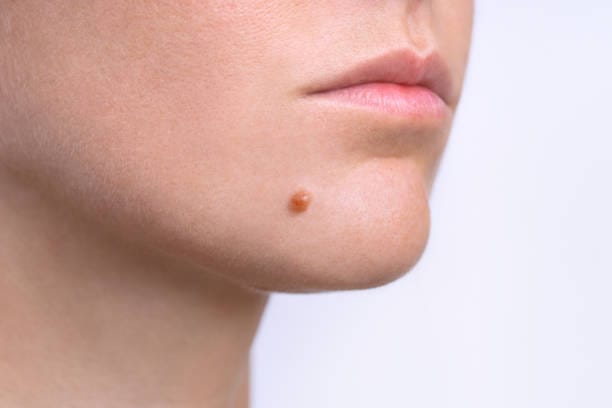 How-Does-Mole-Removal-Work-on-Sensitive-Skin-Areas