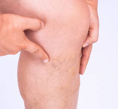 How-Does-Spider-Vein-Treatment-Improve-Skin-Tone