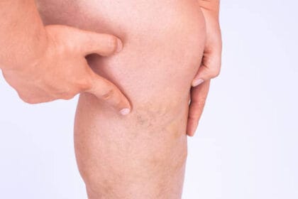 How-Does-Spider-Vein-Treatment-Improve-Skin-Tone