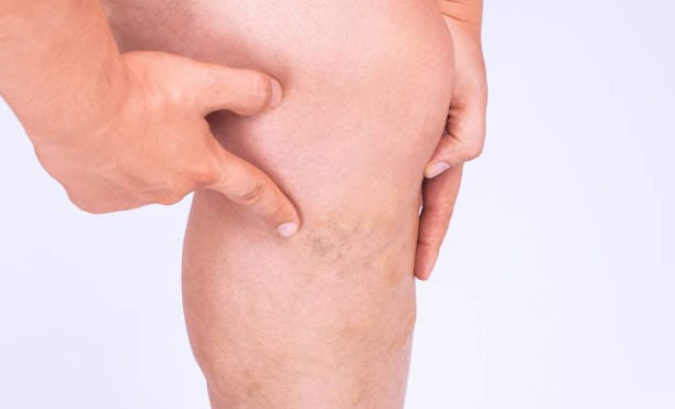 How-Does-Spider-Vein-Treatment-Improve-Skin-Tone