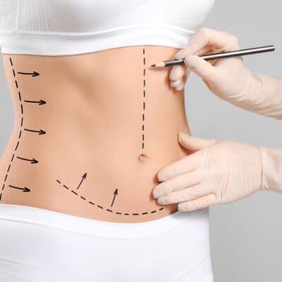 How-Does-a-Tummy-Tuck-Benefit-Your-Health-Overall