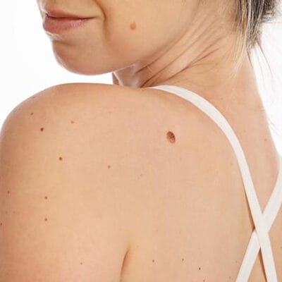 How-Fast-Is-Recovery-After-Skin-Tag-Removal