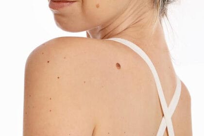 How-Fast-Is-Recovery-After-Skin-Tag-Removal