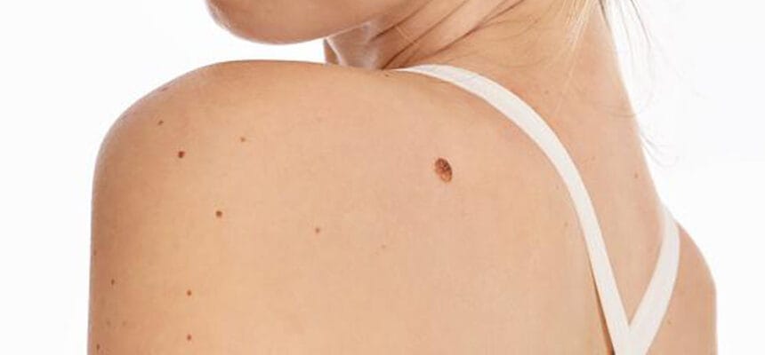 How-Fast-Is-Recovery-After-Skin-Tag-Removal