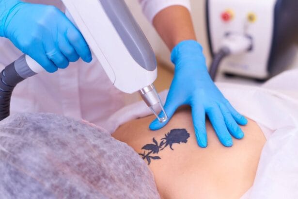 How-Laser-Tattoo-Removal-Breaks-Ink-Particles