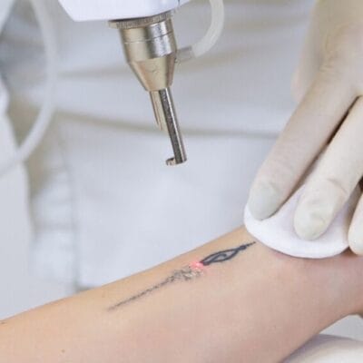 How-Long-Before-Tattoo-Removal-Shows-Visible-Results