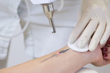 How-Long-Before-Tattoo-Removal-Shows-Visible-Results