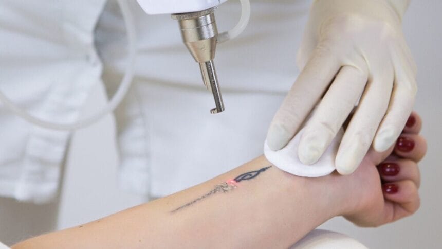 How-Long-Before-Tattoo-Removal-Shows-Visible-Results