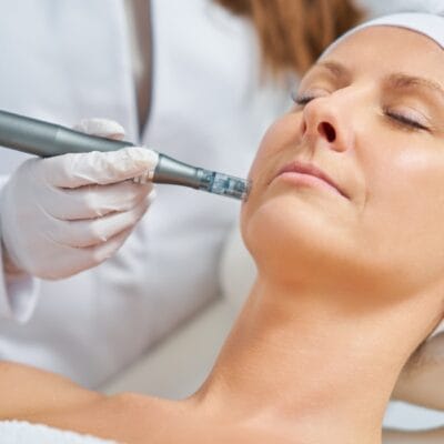 How-Long-Do-Microneedling-Results-Last