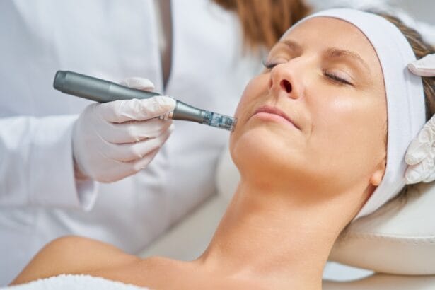 How-Long-Do-Microneedling-Results-Last