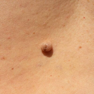 How-Long-Does-Warts-Removal-Take-to-Show-Results