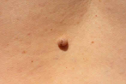How-Long-Does-Warts-Removal-Take-to-Show-Results