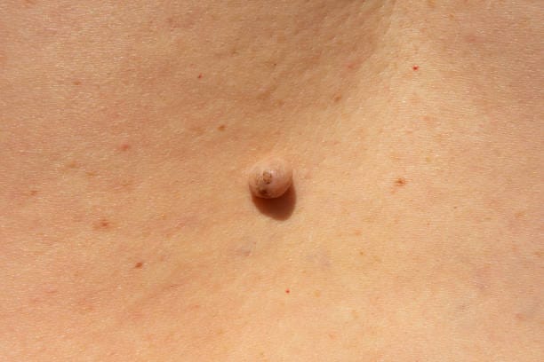 How-Long-Does-Warts-Removal-Take-to-Show-Results