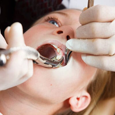 How-Soon-Can-You-Recover-From-Tooth-Removal