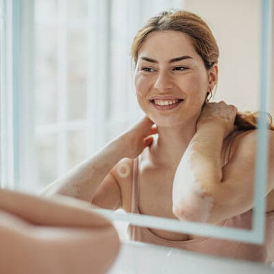 How-to-prepare-for-vitiligo-treatment-sessions