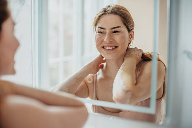 How-to-prepare-for-vitiligo-treatment-sessions