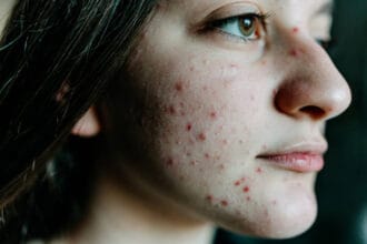 Is-Laser-Acne-Scar-Treatment-Safe-for-All-Skin-Types