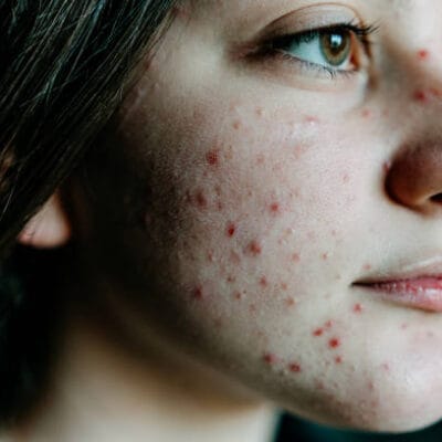 Is-Laser-Acne-Scar-Treatment-Safe-for-All-Skin-Types