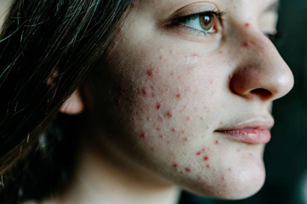 Is-Laser-Acne-Scar-Treatment-Safe-for-All-Skin-Types