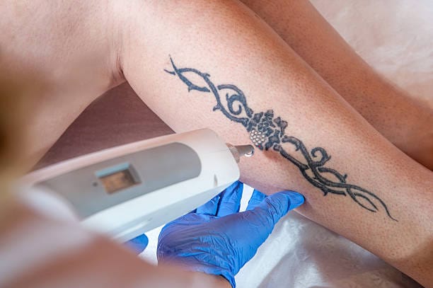 Is-Picosure-Tattoo-Removal-Right-for-Body-Tattoos