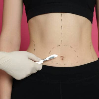 What-Are-the-Long-Term-Benefits-of-Liposuction