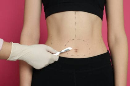 What-Are-the-Long-Term-Benefits-of-Liposuction