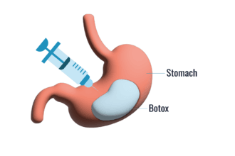 What-Gastric-Botox-Can-Do-for-Your-Appetite