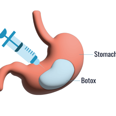 What-Gastric-Botox-Can-Do-for-Your-Appetite