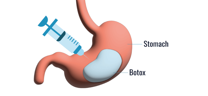 What-Gastric-Botox-Can-Do-for-Your-Appetite