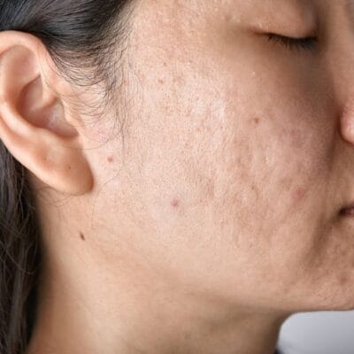 What-Laser-Acne-Scar-Treatment-Can-Really-Fix