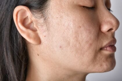 What-Laser-Acne-Scar-Treatment-Can-Really-Fix