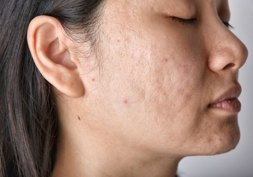 What-Laser-Acne-Scar-Treatment-Can-Really-Fix
