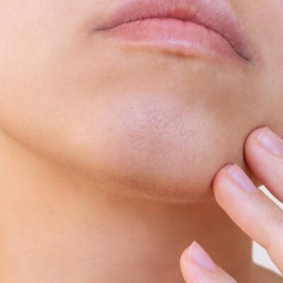 What-Makes-You-a-Good-Candidate-for-Double-Chin-Liposuction