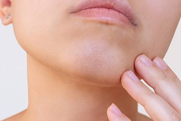 What-Makes-You-a-Good-Candidate-for-Double-Chin-Liposuction