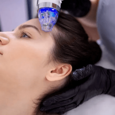 What-Should-You-Avoid-After-RF-Micro-Needling