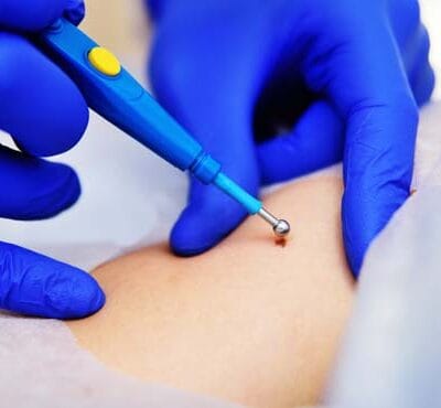 What-Should-You-Avoid-After-Warts-Removal-Treatment
