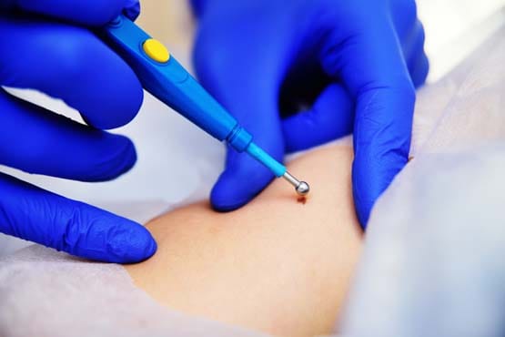 What-Should-You-Avoid-After-Warts-Removal-Treatment