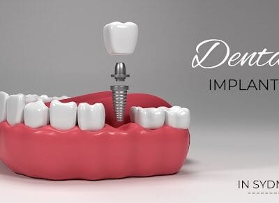 dental-implants-in-sydney