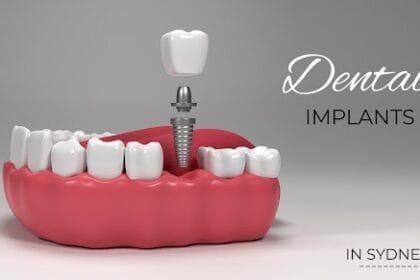 dental-implants-in-sydney