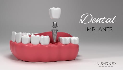 dental-implants-in-sydney